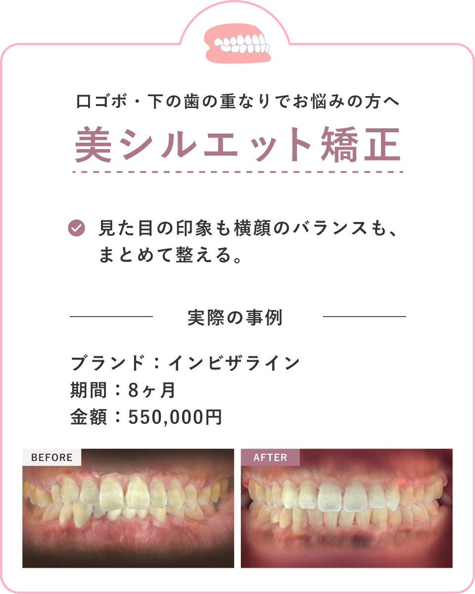 美シルエット矯正