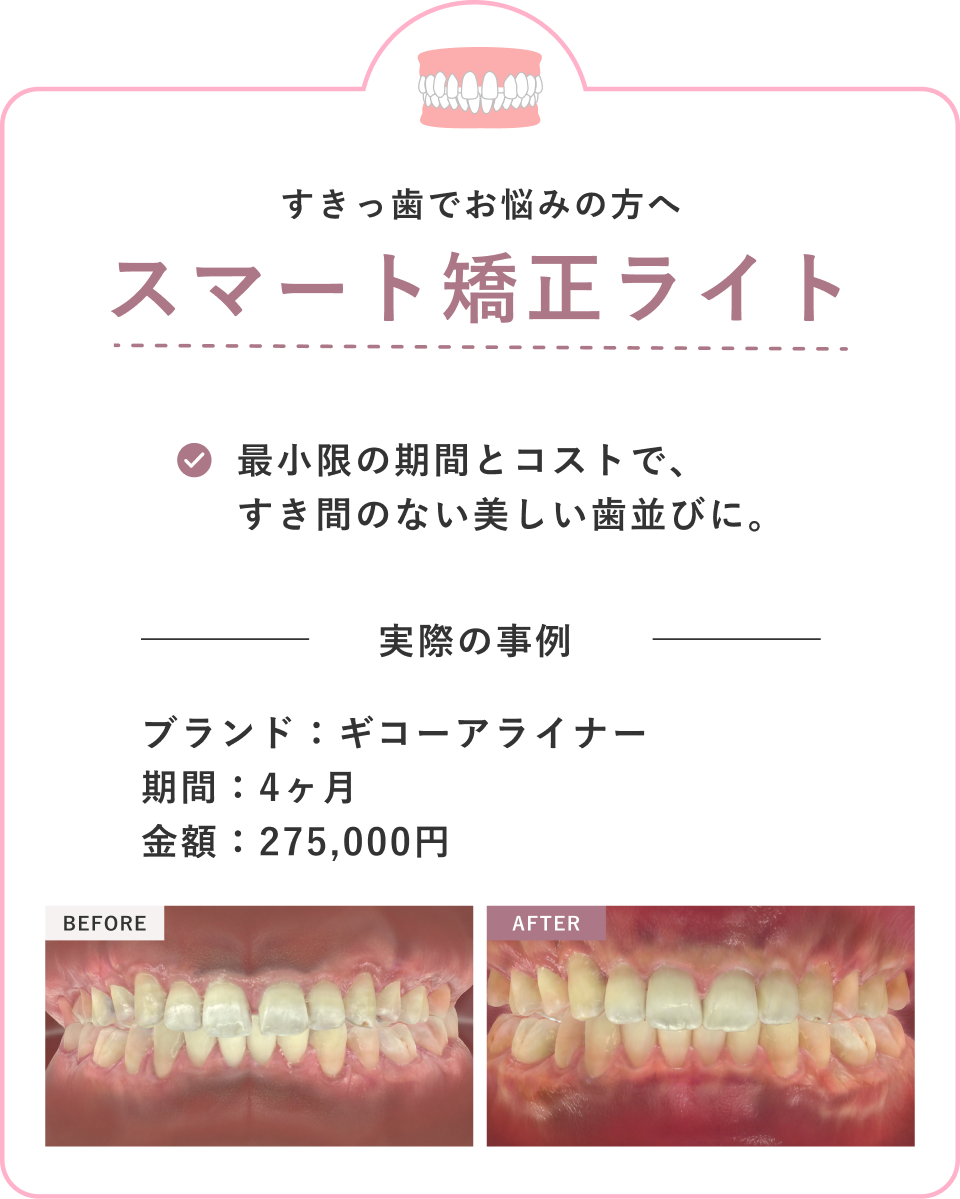 スマート矯正ライト