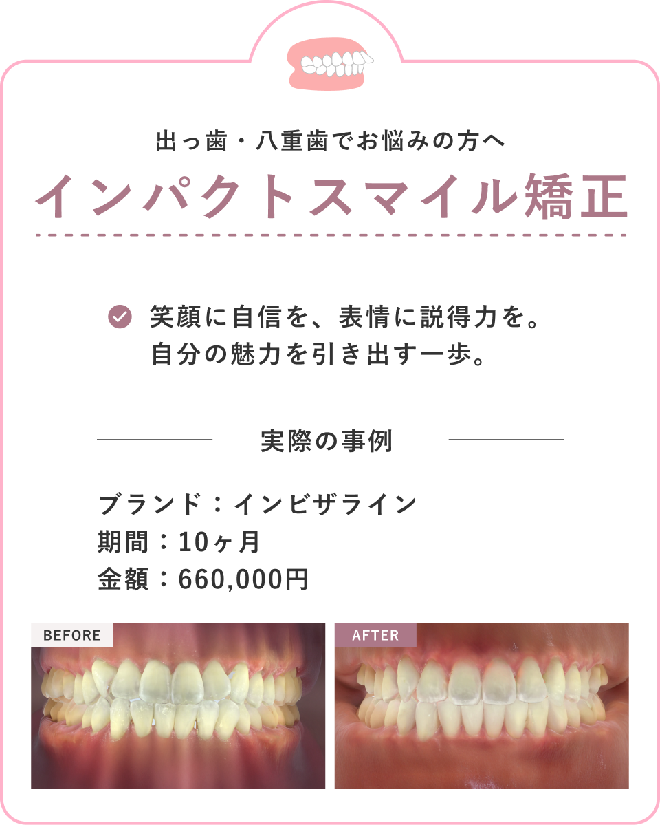 インパクトスマイル矯正