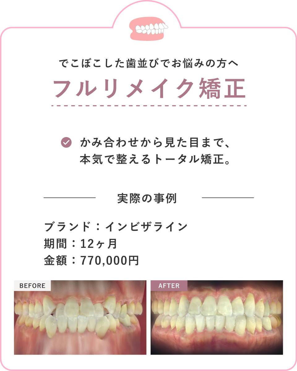 フルリメイク矯正